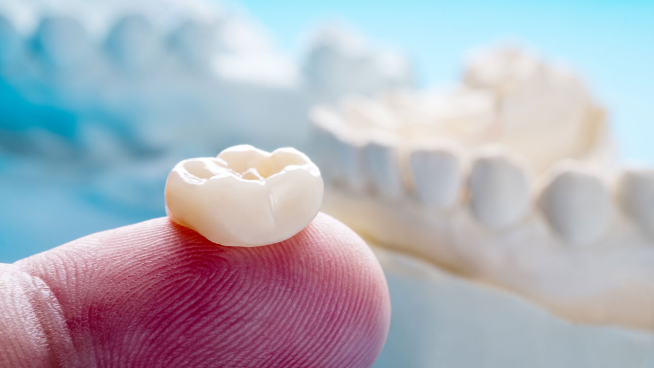 CEREC Crowns
