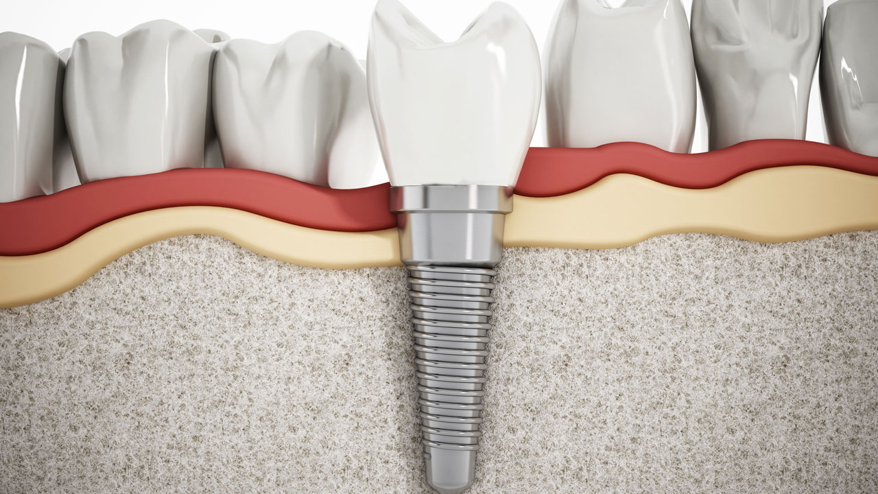 Dental Implants